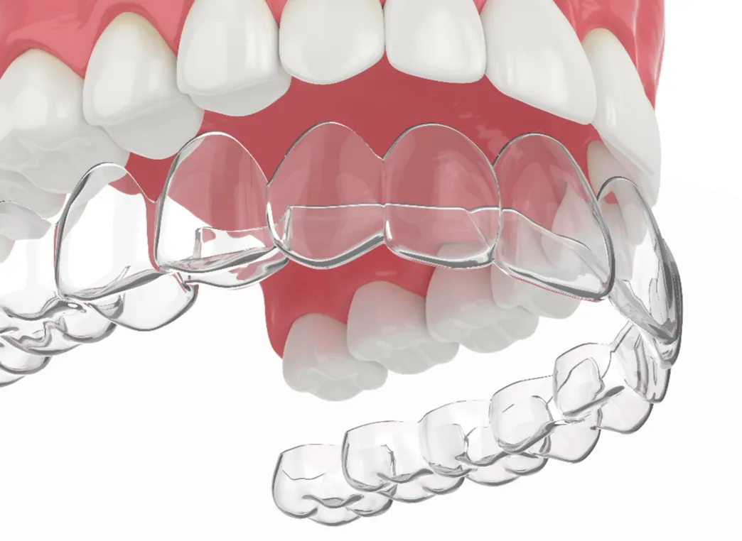 Clear Smile Aligners