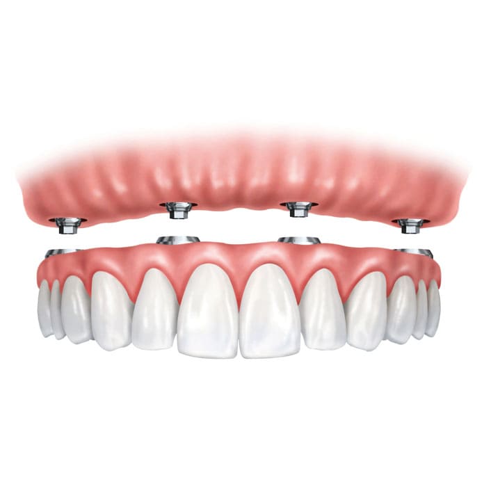 Implant Supported Dentures