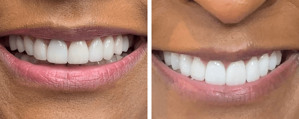 Cosmetic Dentist Before After 1