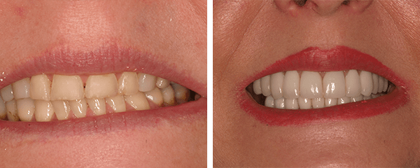 Cosmetic Dentist Before After 2