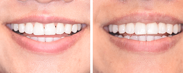 Cosmetic Dentist Before After 5