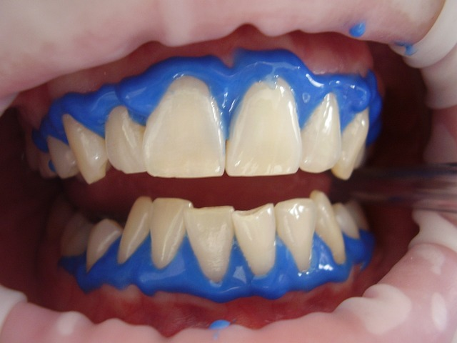 laser teeth whitening, dental, whitening